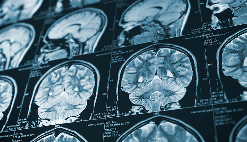 brain CT scan